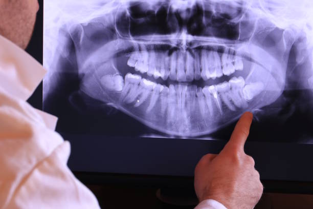 Best Emergency Wisdom Teeth Removal in Amarillo, TX