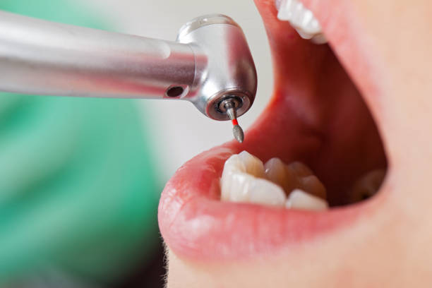 Best Emergency Wisdom Teeth Removal in Amarillo, TX
